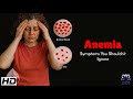 Anemia Symptoms You Shouldn’t Ignore : A Guide to What’s Really Going On