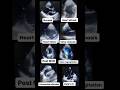 Echocardiogram NORMAL Vs ABNORMAL Radiology Cardiology