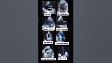 Echocardiogram NORMAL vs ABNORMAL! #radiology #cardiology