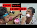 Clinical examination of buccal carcinoma step by step demonstration