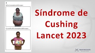 Hay algo nuevo en Síndrome de Cushing?? (Cushing syndrome Lancet 2023)