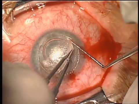 My DALK surgery performed by Prof. Dr. Theo Seiler - part 1