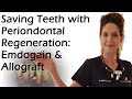 Saving teeth with periodontal regeneration emdogain  allograft