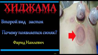 Второй вид застоя Обучение Хиджаме alhajam.ru Второй вид застоя Обучение Хиджаме alhajam.ru
