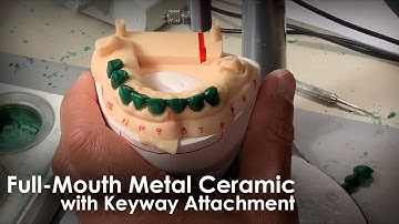 Full Mouth Ceramic with Keyway Attachment