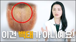 치과의사가 알려주는 백태 한번에 없애는 방법!!ㅣ구취 끝~😊