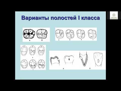Препарирование кариозных полостей