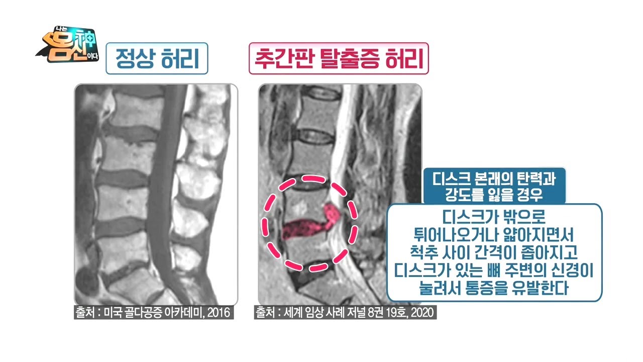 추간판탈출증, 척추병원에서는 허리통증치료 어떻게? 4