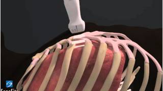 3D Comment Échographie Pulmonaire - Échographe Sonosite
