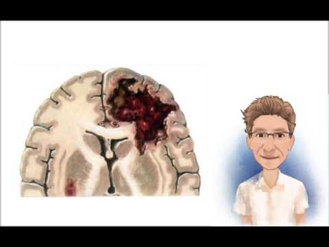 Vídeo: Cirugía Para Hemorragia Intracerebral Espontánea