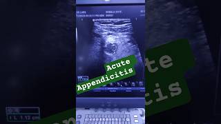Acute Appendicitis