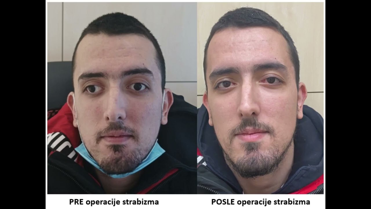 Iskustvo pacijenta nakon estetske operacije strabizma u specijalnoj bolnici Sveti Vid