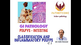 Intestinal Polyps - Classification and Inflammatory Polyps