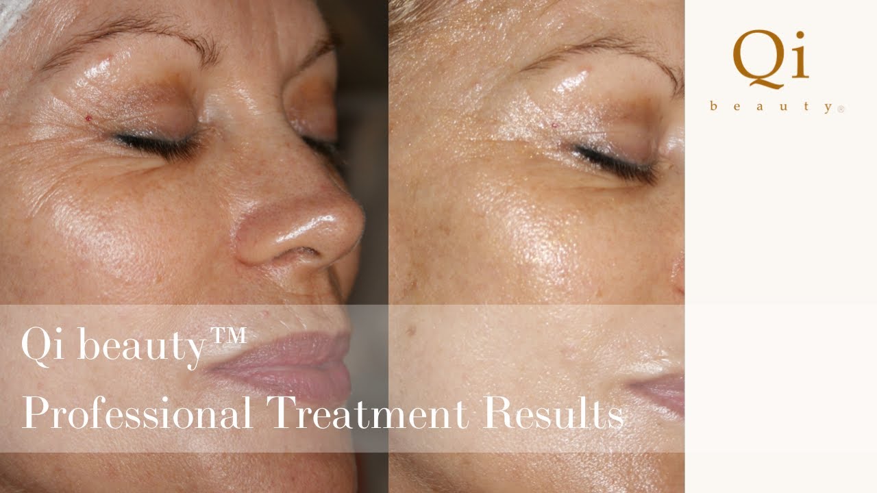 Qi beauty professional treatments and results YouTube