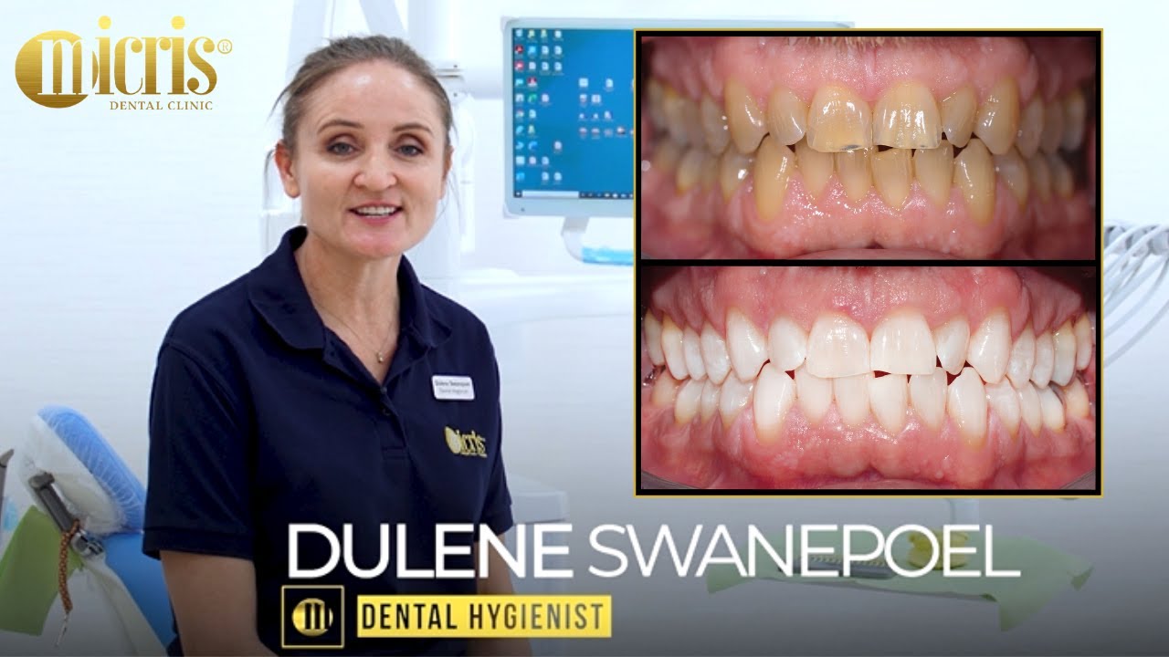 The Journey of Teeth Whitening - Patient Experience