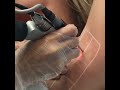 Laser Hair Removal in session at my clinic @epiliumlondon