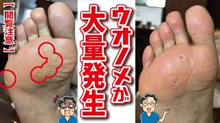 【大量除去】踏み場もないほど広がった魚の目。ガチガチの足裏を「全摘出」します