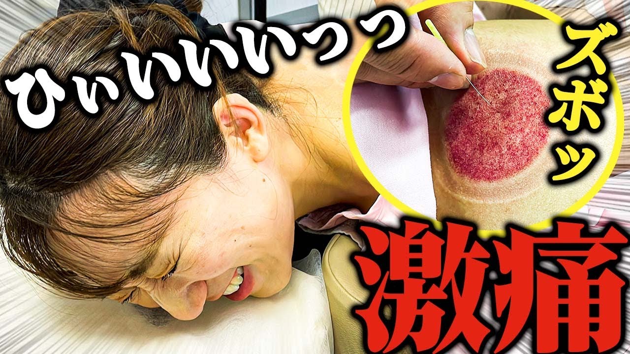 【吸い玉　肩甲骨はがし】瘀血大量発覚　3か月ぶりのメンテ　重症でした肩甲骨を吸い玉と鍼でガッツリ治療　11円で自分でケア出来る方法も伝授【銀座日本橋　横浜元町　鍼灸院】