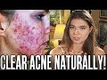 CLEAR YOUR ACNE NATURALLY (ft. Nina & Randa)