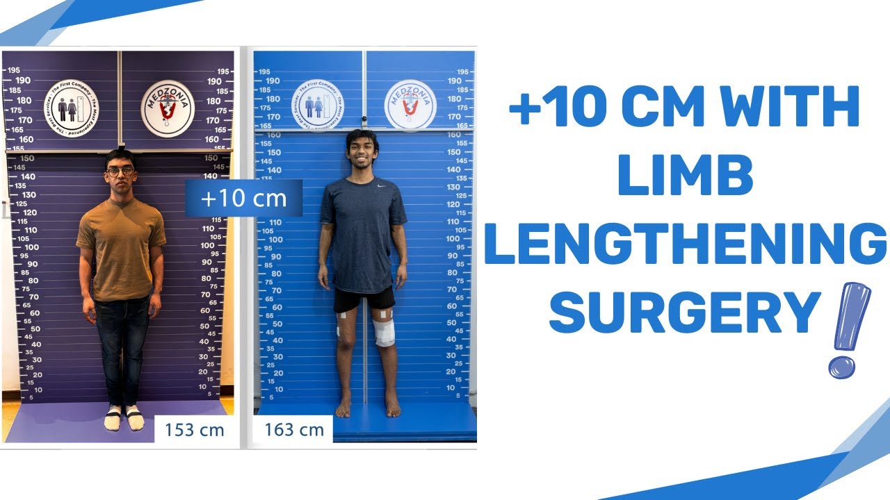 10-cm-with-limb-lengthening-surgery-youtube
