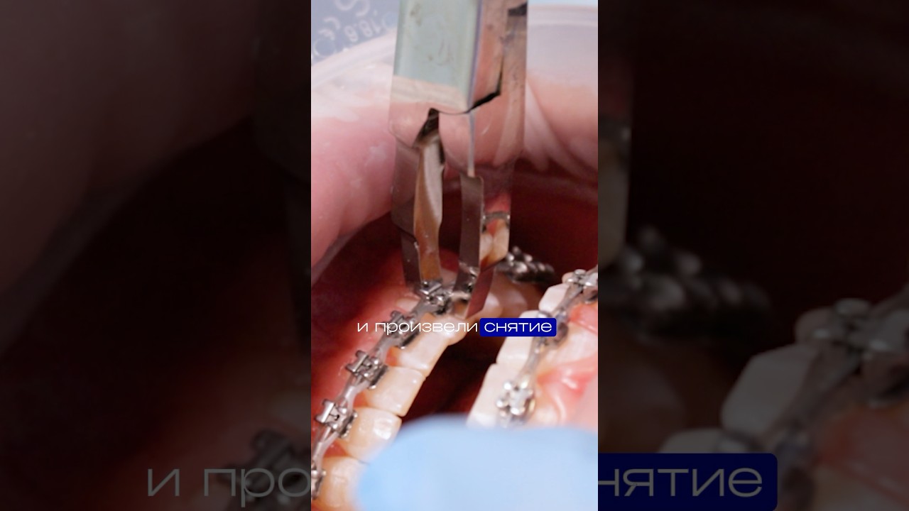 Исправили прикус с помощью брекетов! Результат удивил🔥#брекеты #зубы #прикус #диастема #подросток