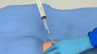 tianshi liječenje artroze plus liječenje osteoartritisa