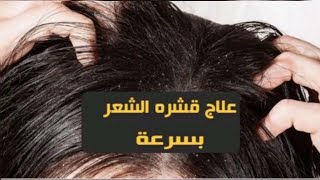 التخلص من القشرة والحكة والفطريات فروة الشعر بمكونين فقط من استعمال الاول جرب الوصفة اودعي  معايا ?