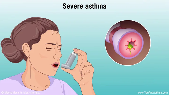 Understanding Asthma: Mild, Moderate, and Severe - DayDayNews