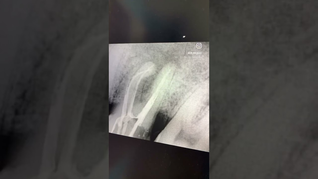 Root Canal Treatment 