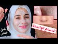 التخلص من المسامات بمكونات طبيعيه متوفره في منزلك هنادى خطاب