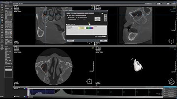 OnDemand3D Tool Tip - Sinus volume measure