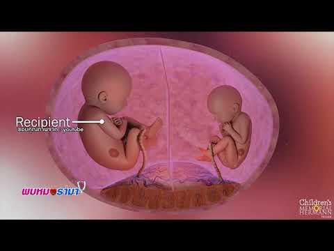 วีดีโอ: วิธีคลอดลูกแฝด