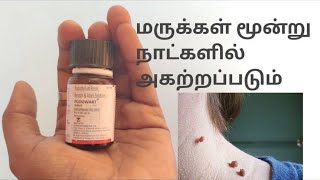 Skin tag or warts or maru remedy in tamil/marukal poga tips/how to remove skin tags,warts in tamil