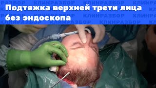 Операция: Подтяжка верхней трети лица без эндоскопа