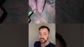 Dermatologist reacts to amazing ingrown hair extraction