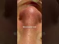 【韓国式3D毛穴洗浄】どこまで綺麗になるのか #blackheads #skincare