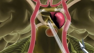 Endoscopic Endonasal Skull Base Surgery - Minimally Invasive Brain Surgery