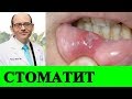 Лечение Стоматита и Витамин B12 - Доктор Майкл Грегер