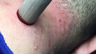 Acne pea | get pustules clean  ( Official Video )