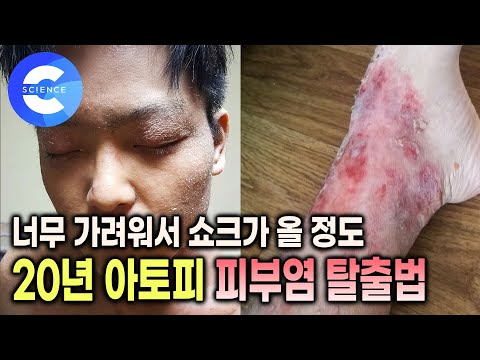 일상생활이 망가지는 지독한 가려움, 과연 좋아질 수 있을까? | 아토피 피부염에 대한 잘못된 오해 바로잡기 | 아토피 피부염 좋아지는 운동법과 식단 | 귀하신몸