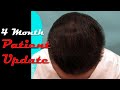 Hair Loss Treatment -  without Surgery