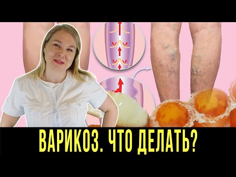 ВАРИКОЗ! ЧТО ДЕЛАТЬ?