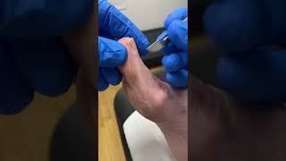 Join Our Aussie Podiatrist For A Satisfying Thick Big Toe Callus Removal! #Podiatry #Footcare 🦶🇦🇺