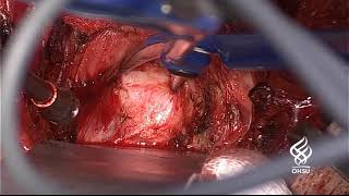 AUA2019 V04-01 Dissection of Neovaginal Space in Gender-affirming Vaginoplasty