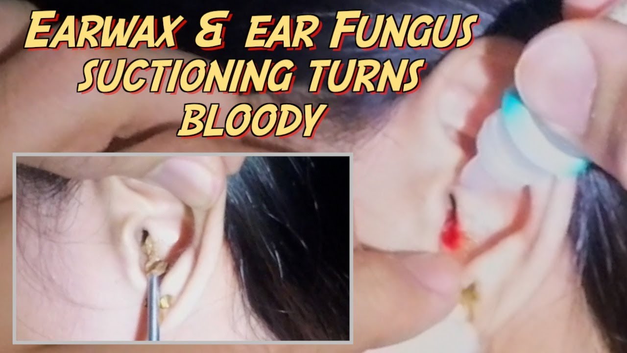 Earwax and Ear Fungus Suctioning Turns Bloody YouTube