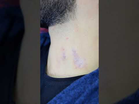 اخفاء المصه