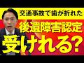 交通事故で歯が折れた場合に後遺障害認定を受けられる?