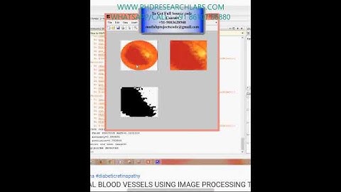 ANALYSIS OF RETINAL BLOOD VESSELS USING IMAGE PROCESSING TECHNIQUES - MATLAB ASSIGNMENTS PROJECT