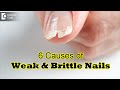 10 Causes of Weak & Brittle Nails | Tips to improve the strength-Dr. Rajdeep Mysore| Doctors' Circle