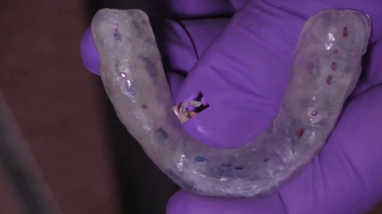 Ajuste de guarda oclusal